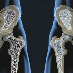 Osteoporosi